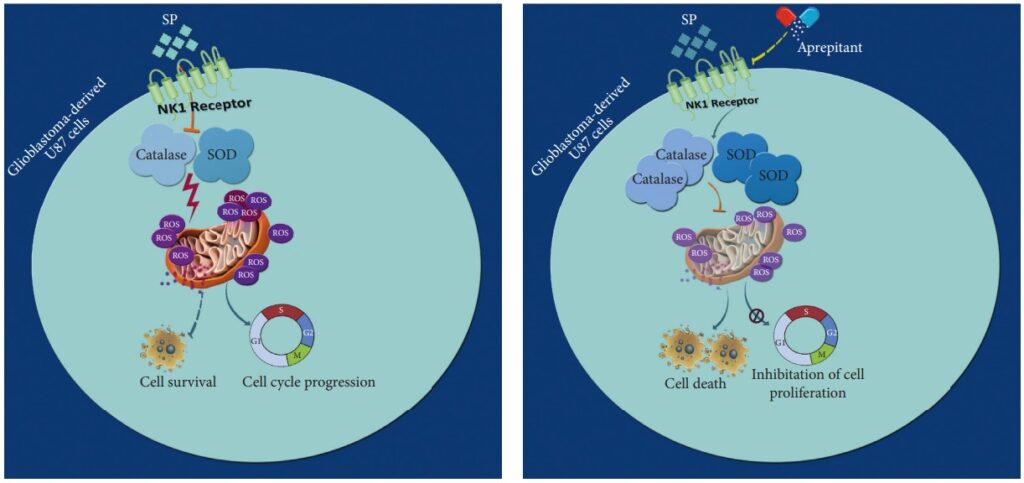 Prospective cure for Glioblastoma cancer with 2dg