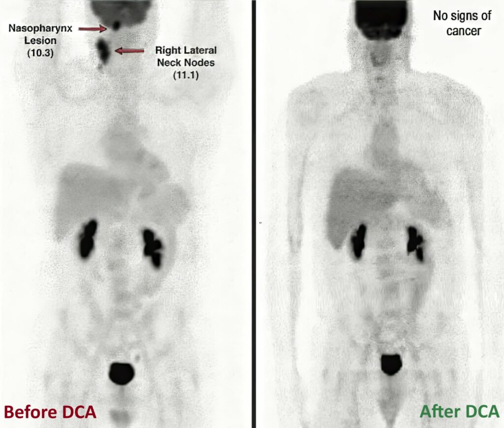 dca and non hodgkin lymphoma