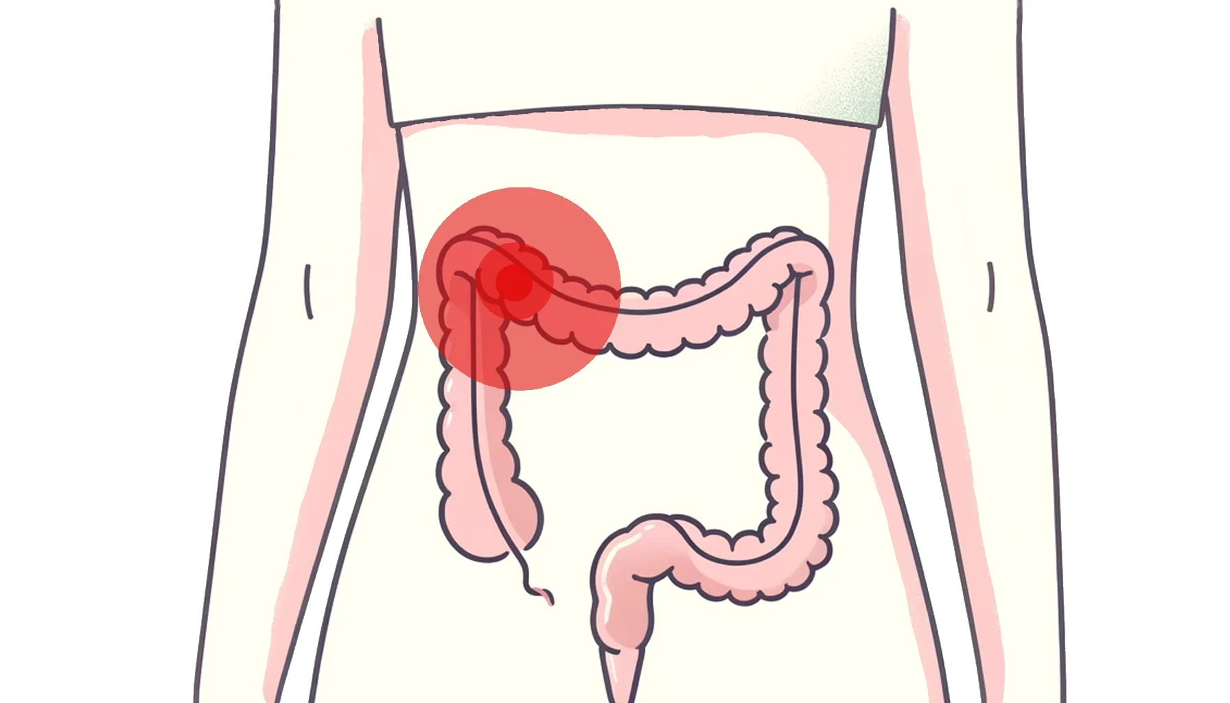 Scopri di più sull'articolo Rapporto su un caso: trattamento del cancro al colon in una donna di 46 anni