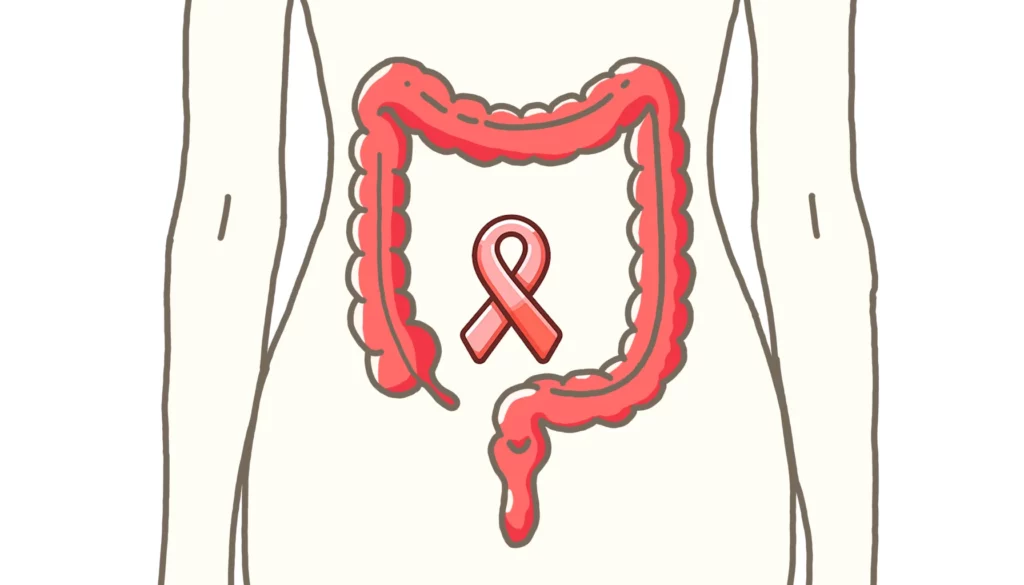 Illustration av en mänsklig överkropp med en kontur av tjocktarmen markerad i rött och ett rosa band för medvetenhet om tjocktarmscancer placerad centralt i den, vilket exemplifierar tjocktarmscancer.