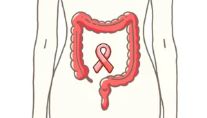 Scopri di più sull'articolo Rapporto su un caso: adenocarcinoma del colon sigmoideo di stadio II in una donna di 64 anni