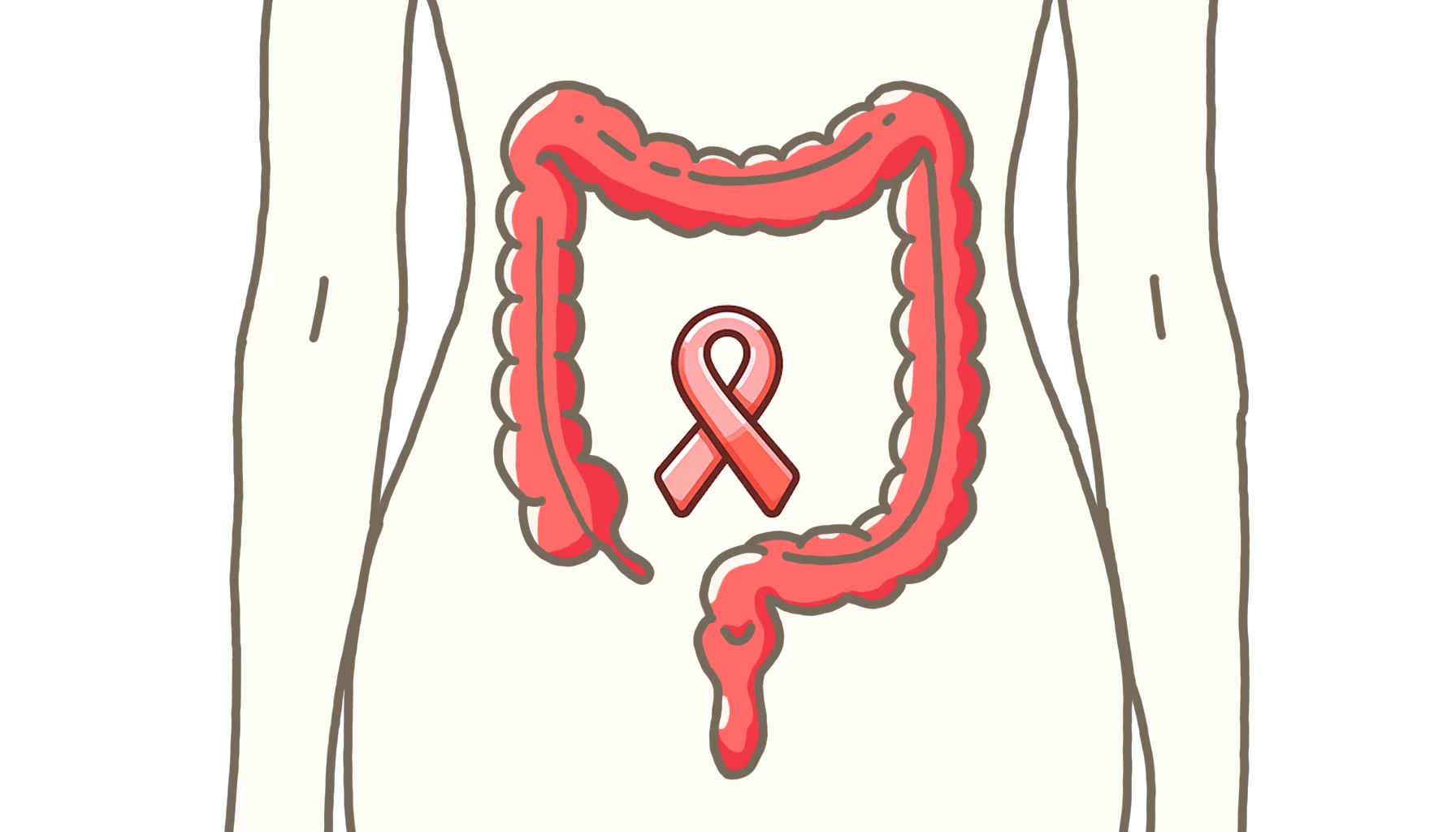 Lire la suite à propos de l’article Rapport de cas : Adénocarcinome du côlon sigmoïde de stade II chez une femme âgée de 64 ans