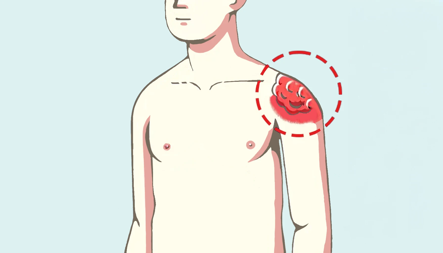 Read more about the article Case Report: Treating Desmoid Tumor (Aggressive Fibromatosis) In A 34-Year-Old