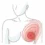Отчет о клиническом случае: тройной негативный рак молочной железы III стадии, женщина, 41 год.