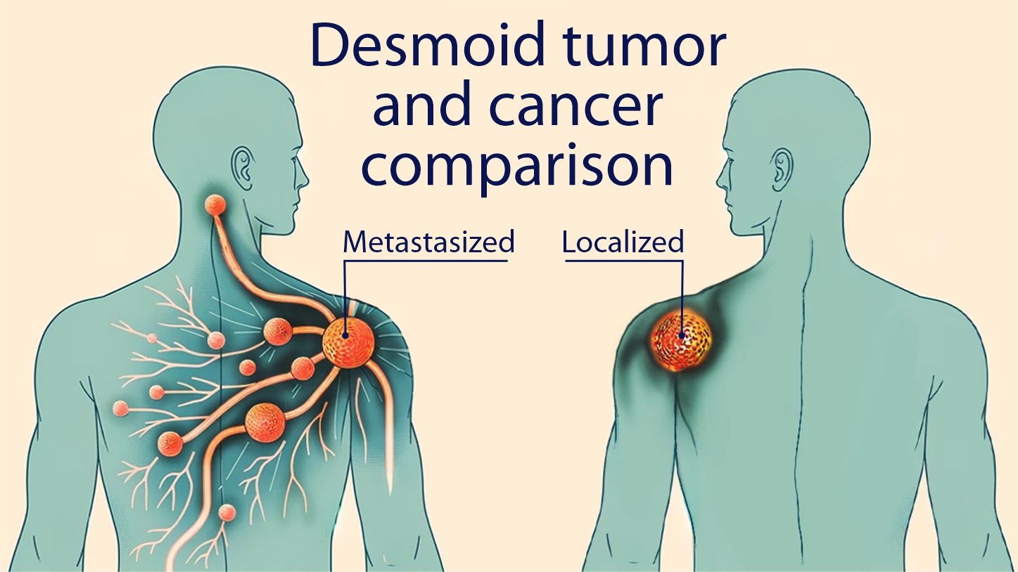 Case Report Treating Desmoid Tumor in a 34YearOldMale