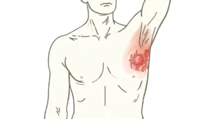 Läs mer om artikeln Fallrapport: Melanom, stadium IV, man, 62 år