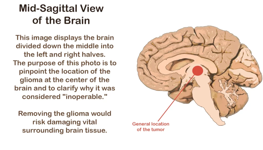 La imagen muestra un glioma de línea media. Es el tipo de cáncer en el cerebro. La imagen corresponde a un informe de caso sobre el uso de fenbendazol para el glioma.